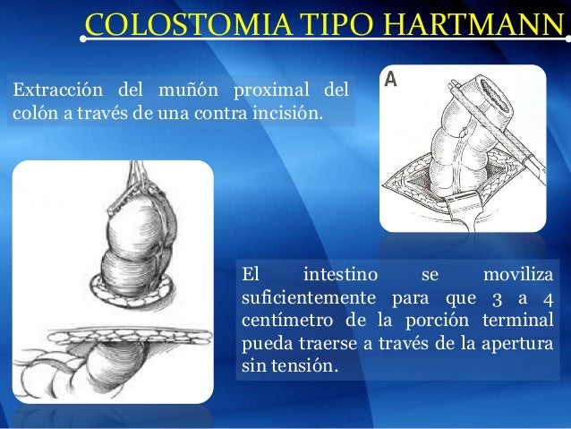 colostomia tipo hartman